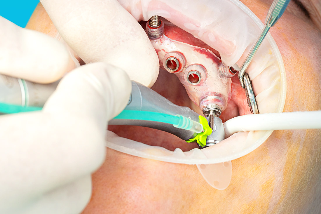 Bohrschablonen - Schollmeier Dental - Hannover und deutschlandweit