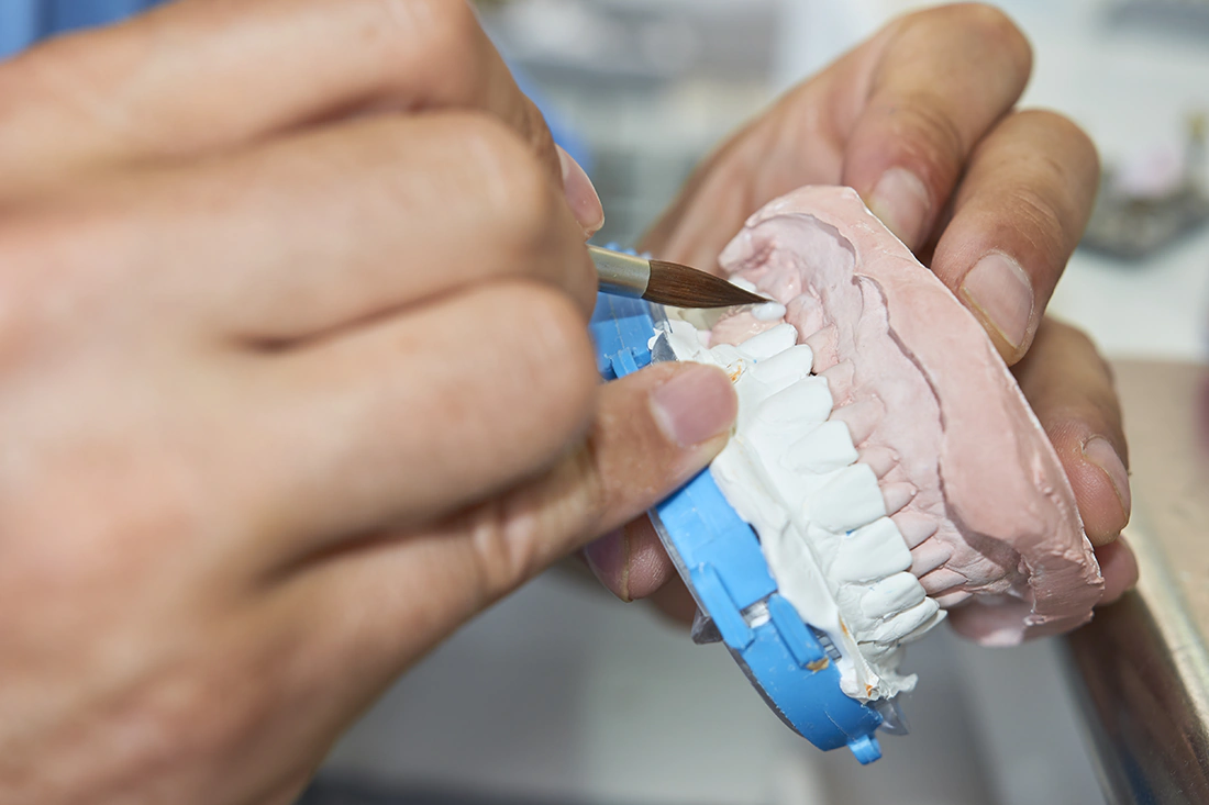 Keramische Verblendungen - Schollmeier Dental