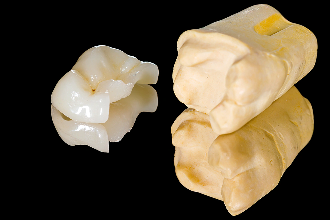 Kronen, Bruecken, Inlays - Schollmeier Dental
