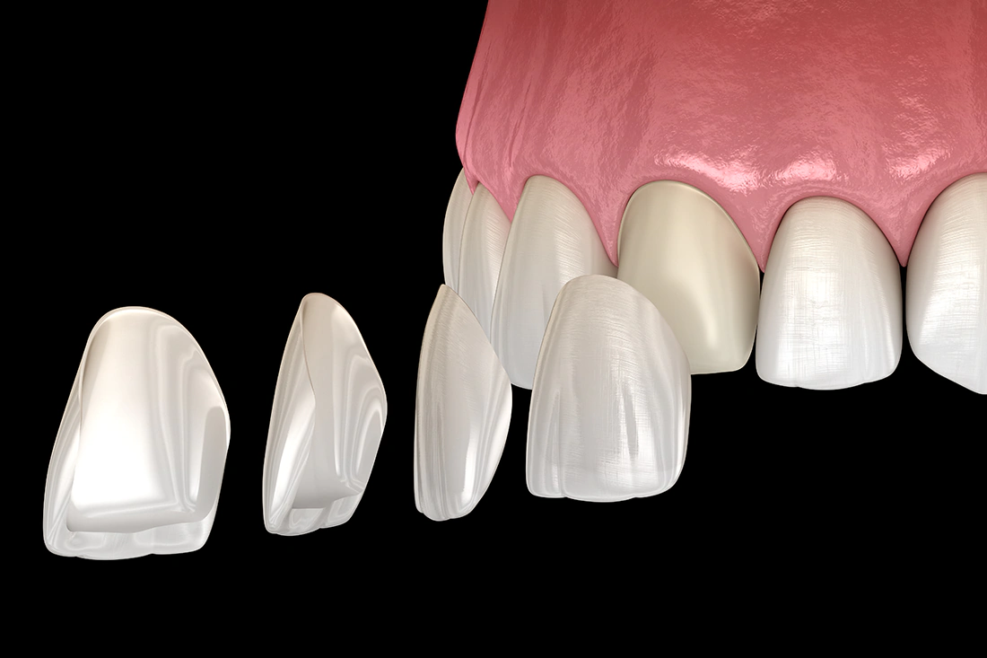 Veneers - Schollmeier Dental - Hannover und deutschlandweit